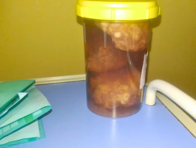 Caillots extraits lors d’une opération de la prostate