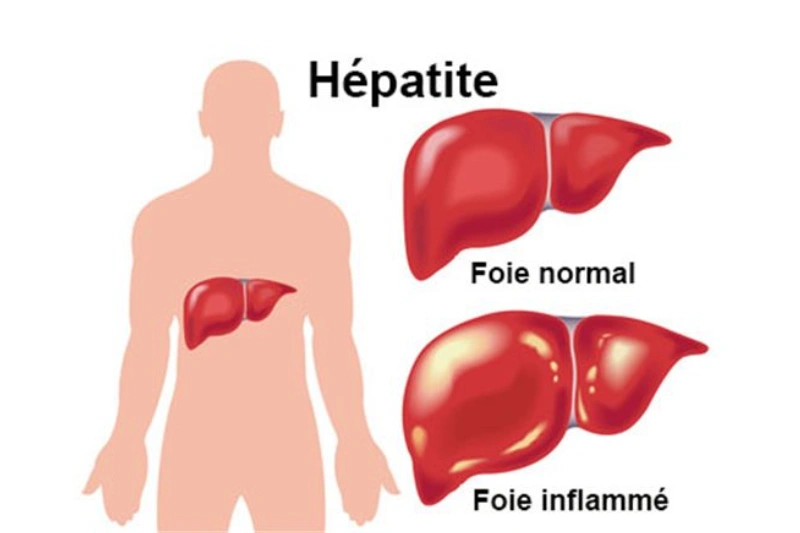 Hépatites : une pathologie qui gagne du terrain au Gabon
