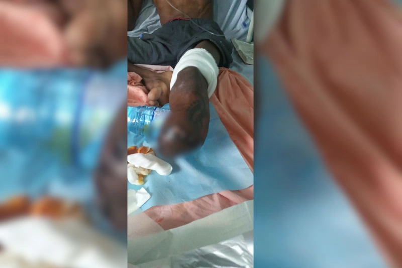 Armel Nkombe est, depuis l’année dernière, condamné à vivre avec une jambe en moins. © DR
