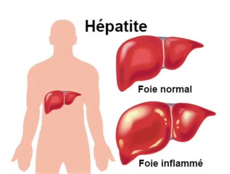 Hépatite