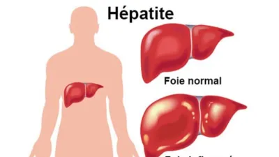 Hépatite
